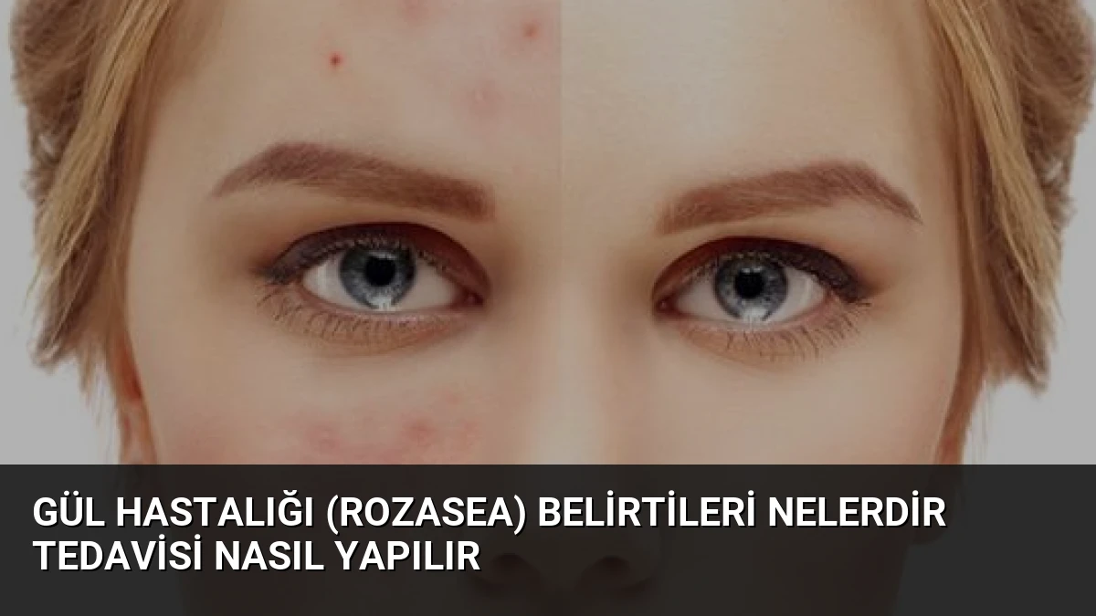 Gül Hastalığı (Rozasea) Belirtileri Nelerdir Tedavisi Nasıl Yapılır