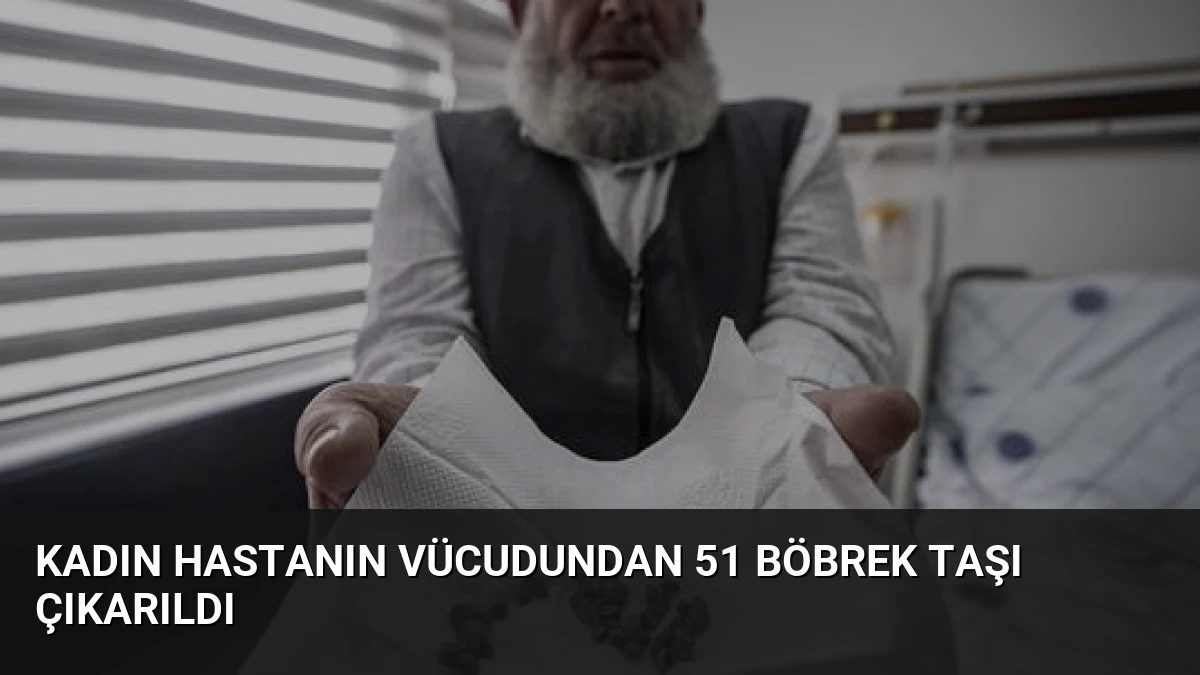 Kadın Hastanın Vücudundan 51 Böbrek Taşı Çıkarıldı