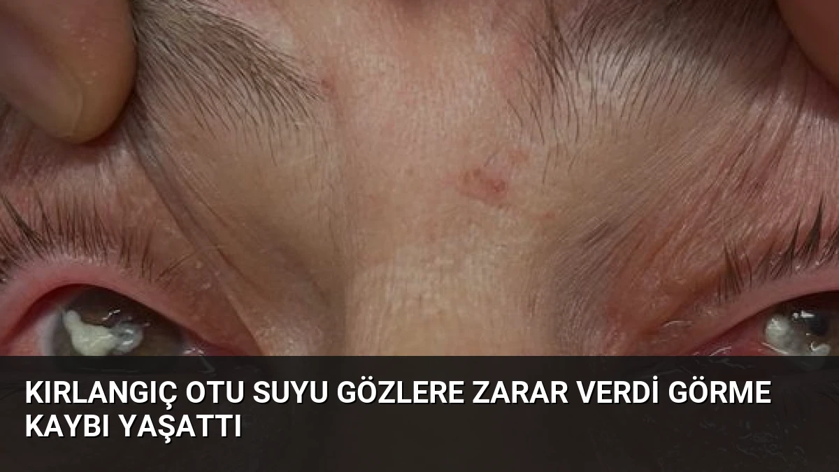 Kırlangıç Otu Suyu Gözlere Zarar Verdi Görme Kaybı Yaşattı