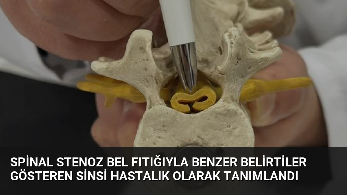 Spinal Stenoz Bel Fıtığıyla Benzer Belirtiler Gösteren Sinsi Hastalık Olarak Tanımlandı