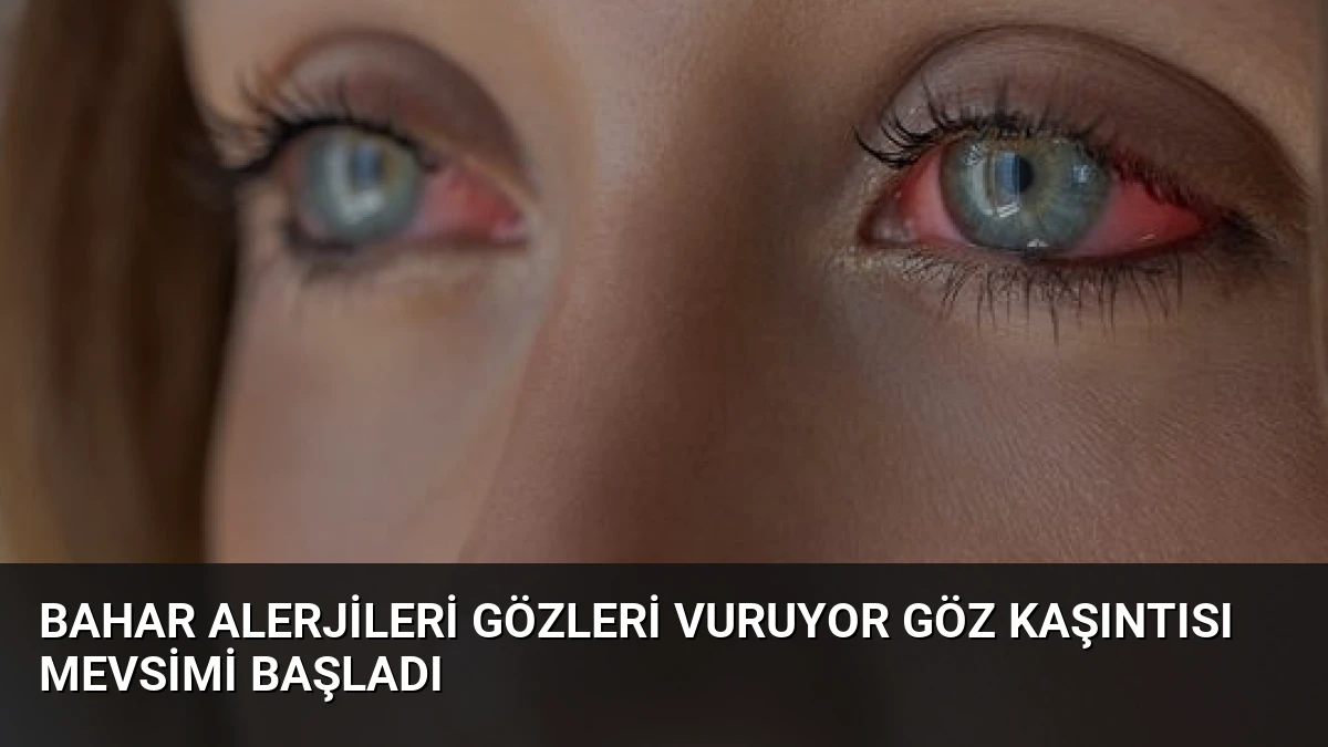 Bahar Alerjileri Gözleri Vuruyor Göz Kaşıntısı Mevsimi Başladı